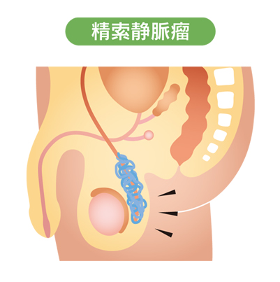 精索静脈瘤（図2）